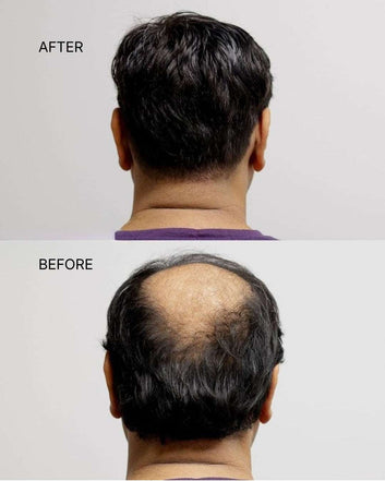 Men Hair Toupee to cover hair loss and hair baldness for men (7x11)
