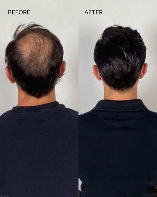 Hair Patch for Men (7X5)