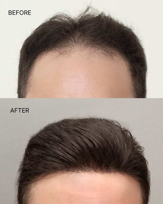 Frontline Hair Patch for men