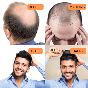 Hair Patch for Men to cover baldness