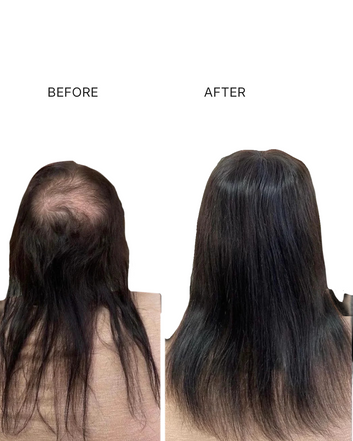 Bald Spot on Head cover up for women (5X6 Inches)